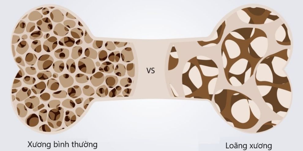 Vì sao phụ nữ dễ bị loãng xương hơn nam giới?